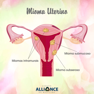 embolização do mioma