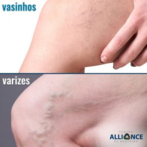 vasinhos varizes